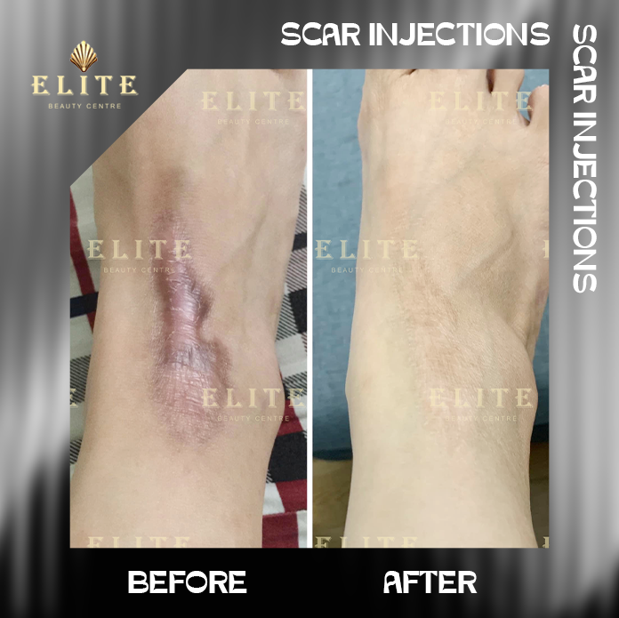 SCAR INJECTION